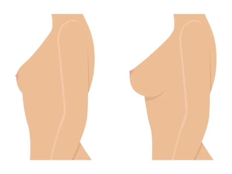 Czy lipofilling biustu jest wart ryzyka? Zalety i wady zabiegu